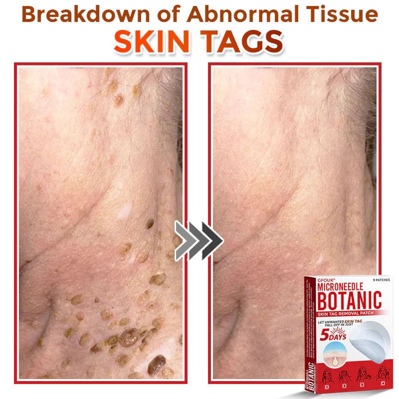 The MicroDerm Patch - Painless Skin Tag & Blemish Removal + 50% OFF - Image 3