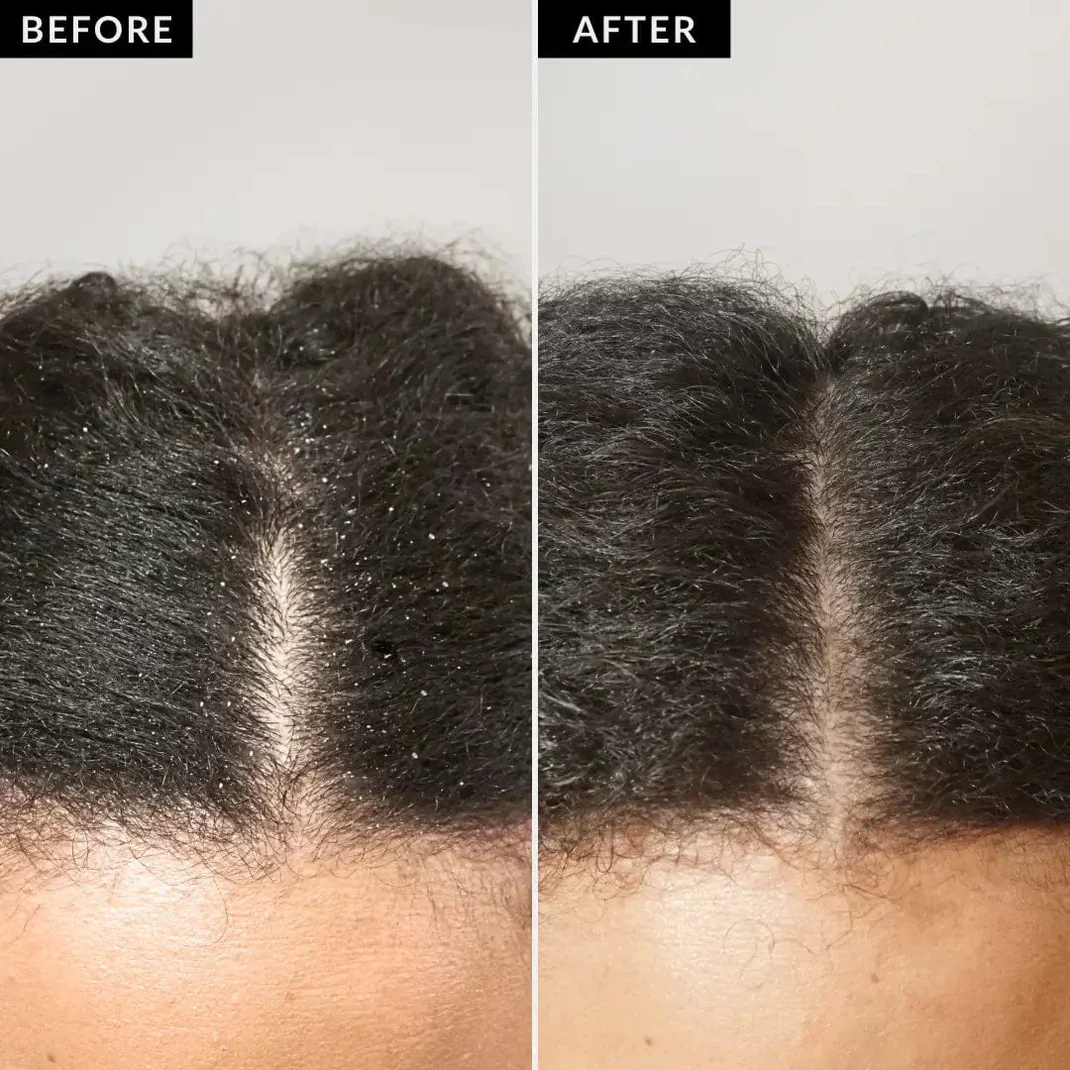 True-Roots Purifying Comb - End Flakes, Stop Itch - 50% OFF - Image 5
